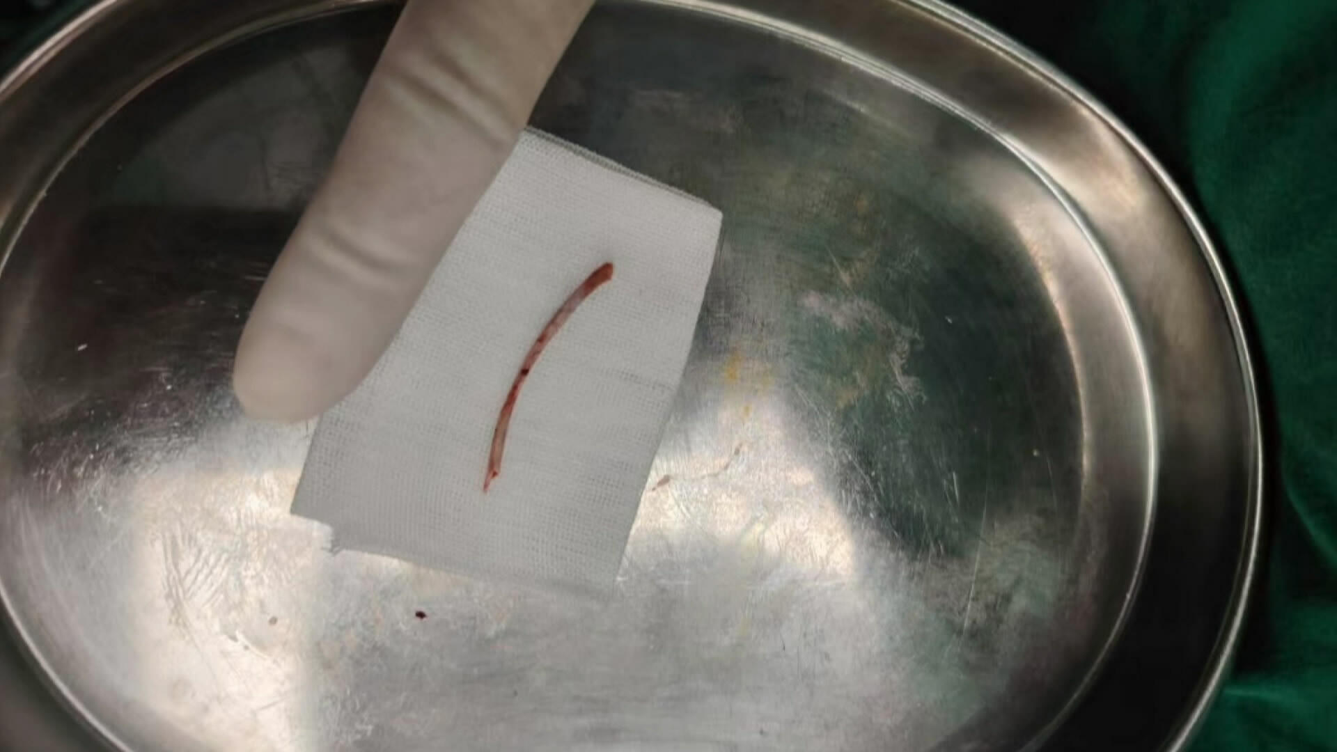 6厘米鱼骨“穿胃破肝” 乐医多学科“腹腔拆弹”生死营救