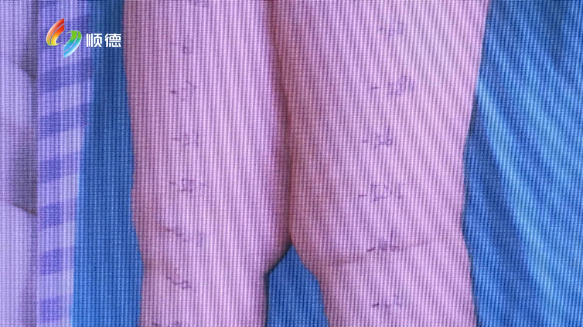 阿姨长成“大象腿” 淋巴水肿惹的祸